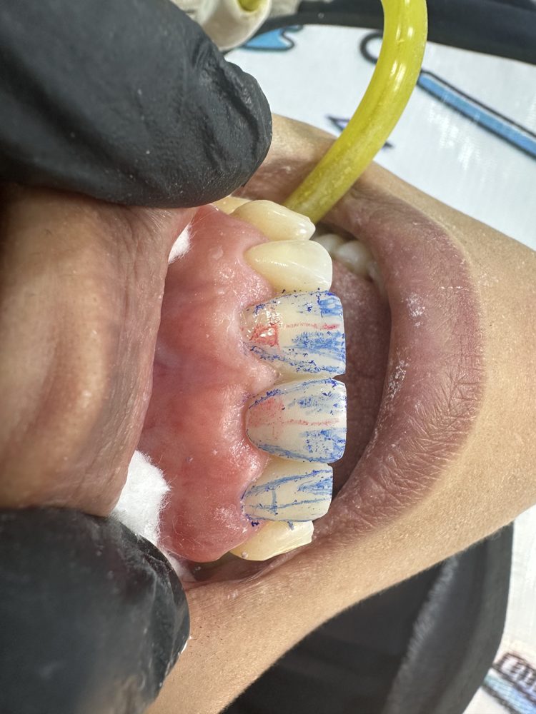 Prótesis fija recuperando pieza dental ausente